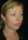 Chin Implant case #4204