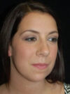 Buccal Fat Removal case #4127