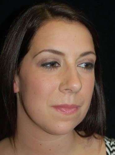 Buccal Fat Removal case #4127