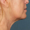 Kybella case #4644