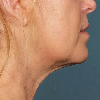 Kybella case #4644