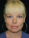 Facial Fat Grafting case #4509