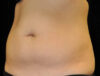 Coolsculpting case #4316