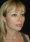 Chin Implant case #4204