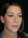 Buccal Fat Removal case #4127