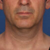 Kybella case #4649