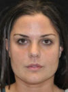 Buccal Fat Removal case #4132