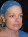 Facial Fat Grafting case #4509