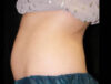 Coolsculpting case #4323