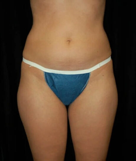 Liposuction case #4692