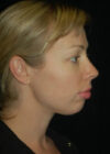 Chin Implant case #4204