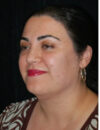 Neck Liposuction case #4954