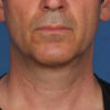 Kybella case #4649
