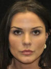 Buccal Fat Removal case #4132