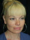 Facial Fat Grafting case #4509