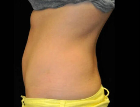 Coolsculpting case #4323