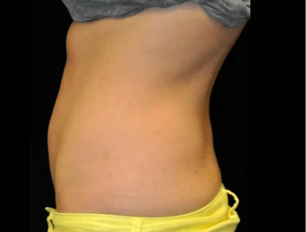 Coolsculpting case #4323