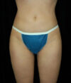 Liposuction case #4692
