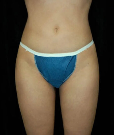 Liposuction case #4692