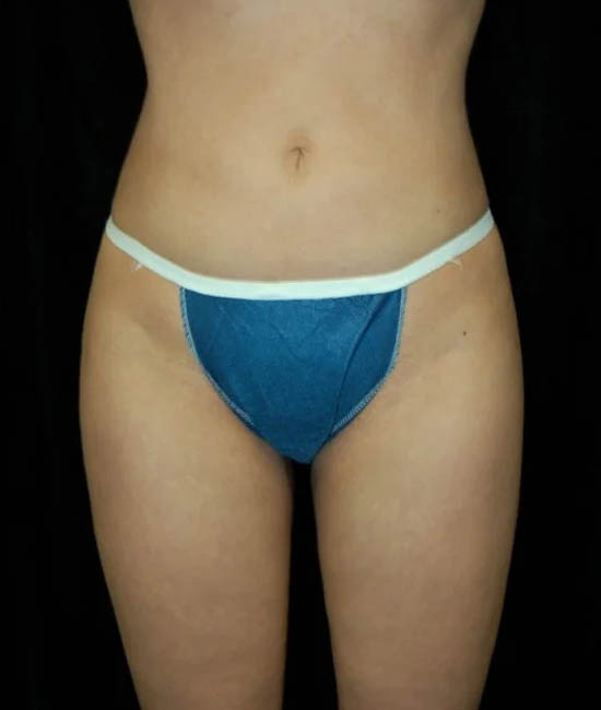 Liposuction case #4692