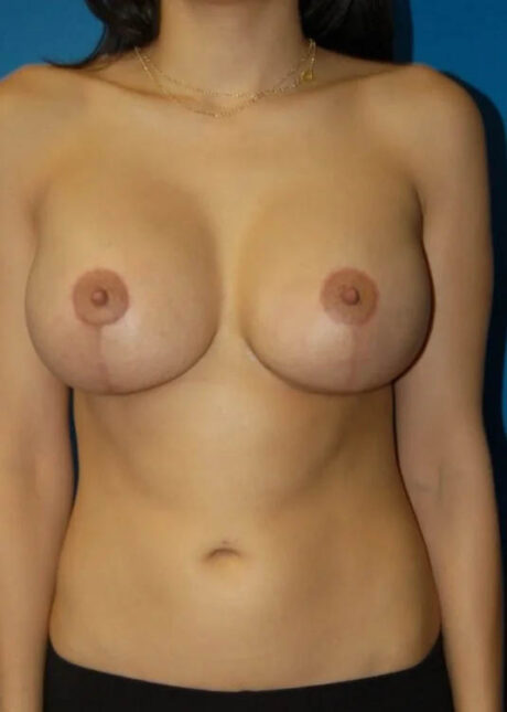 Breast Augmentation with Full Lift case #3940