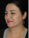 Neck Liposuction case #4954