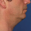 Kybella case #4649