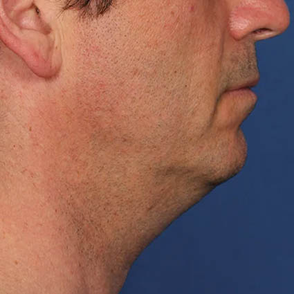 Kybella case #4649