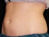 Coolsculpting case #4323