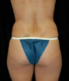 Liposuction case #4692