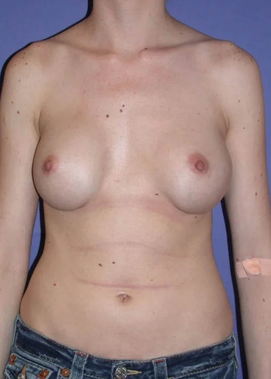 Procedure case #3840