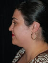 Neck Liposuction case #4954