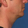 Kybella case #4649