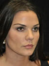 Buccal Fat Removal case #4132