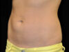 Coolsculpting case #4323