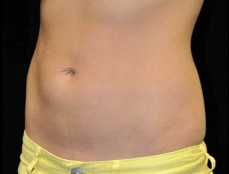 Coolsculpting case #4323