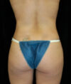 Liposuction case #4692