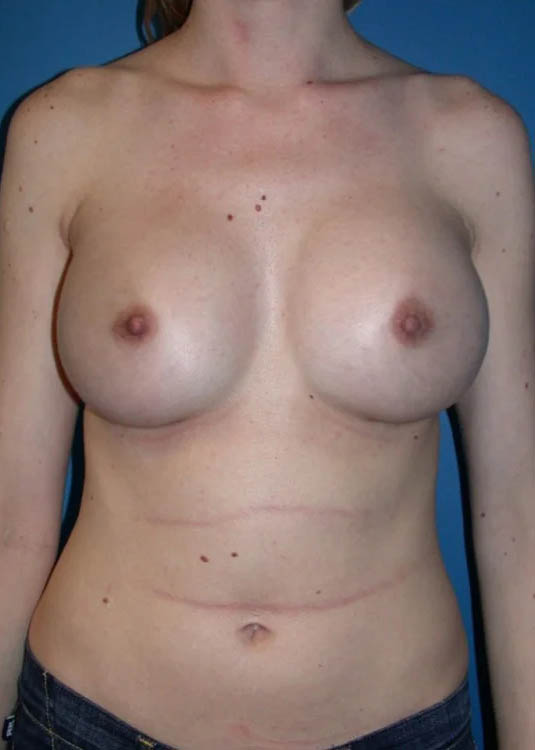 Procedure case #3840