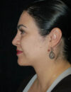 Neck Liposuction case #4954
