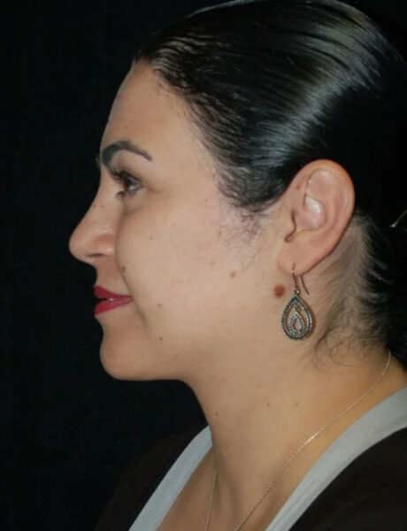 Neck Liposuction case #4954