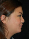 Buccal Fat Removal case #4137
