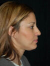 Neck Liposuction case #4959