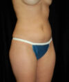 Liposuction case #4692