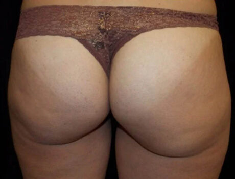 Coolsculpting case #4328