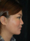 Buccal Fat Removal case #4137