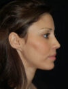 Neck Liposuction case #4959