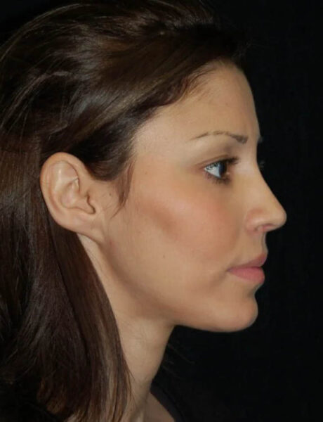 Neck Liposuction case #4959
