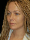 Facial Fat Grafting case #4514