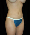 Liposuction case #4692