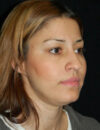 Neck Liposuction case #4959